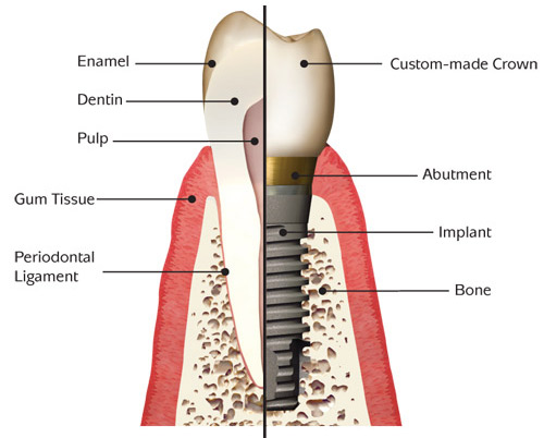 free dental implants in san diego