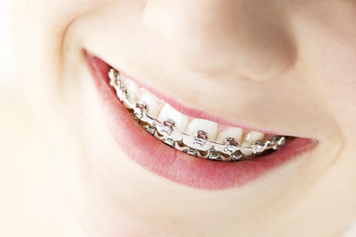 braces in san diego