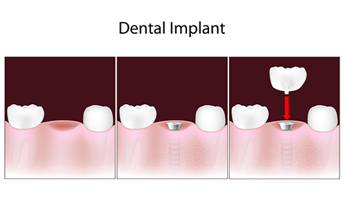 free dental implants in san diego